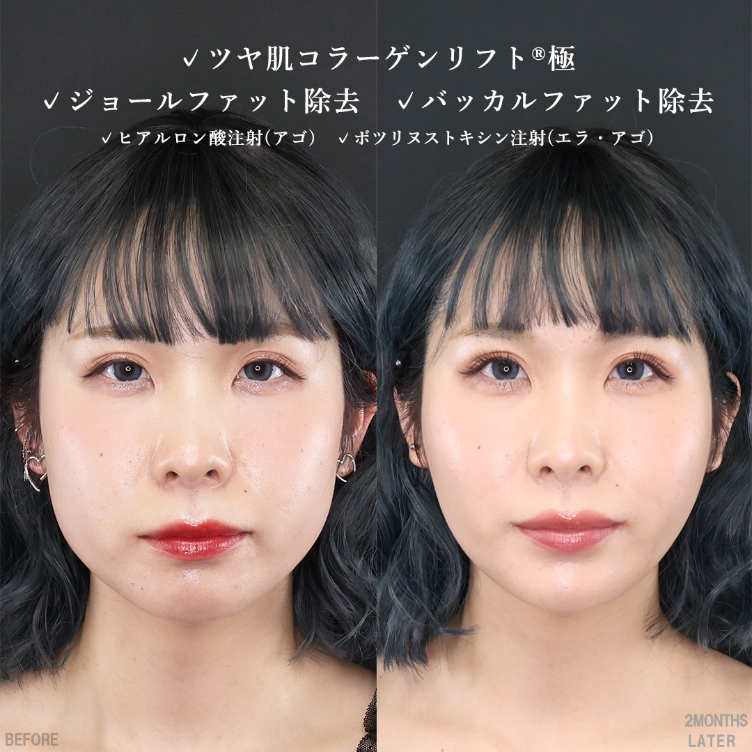 TAC式 ツヤ肌コラーゲンリフト®/ジョールファット除去/バッカルファット除去の症例写真 施術前後 