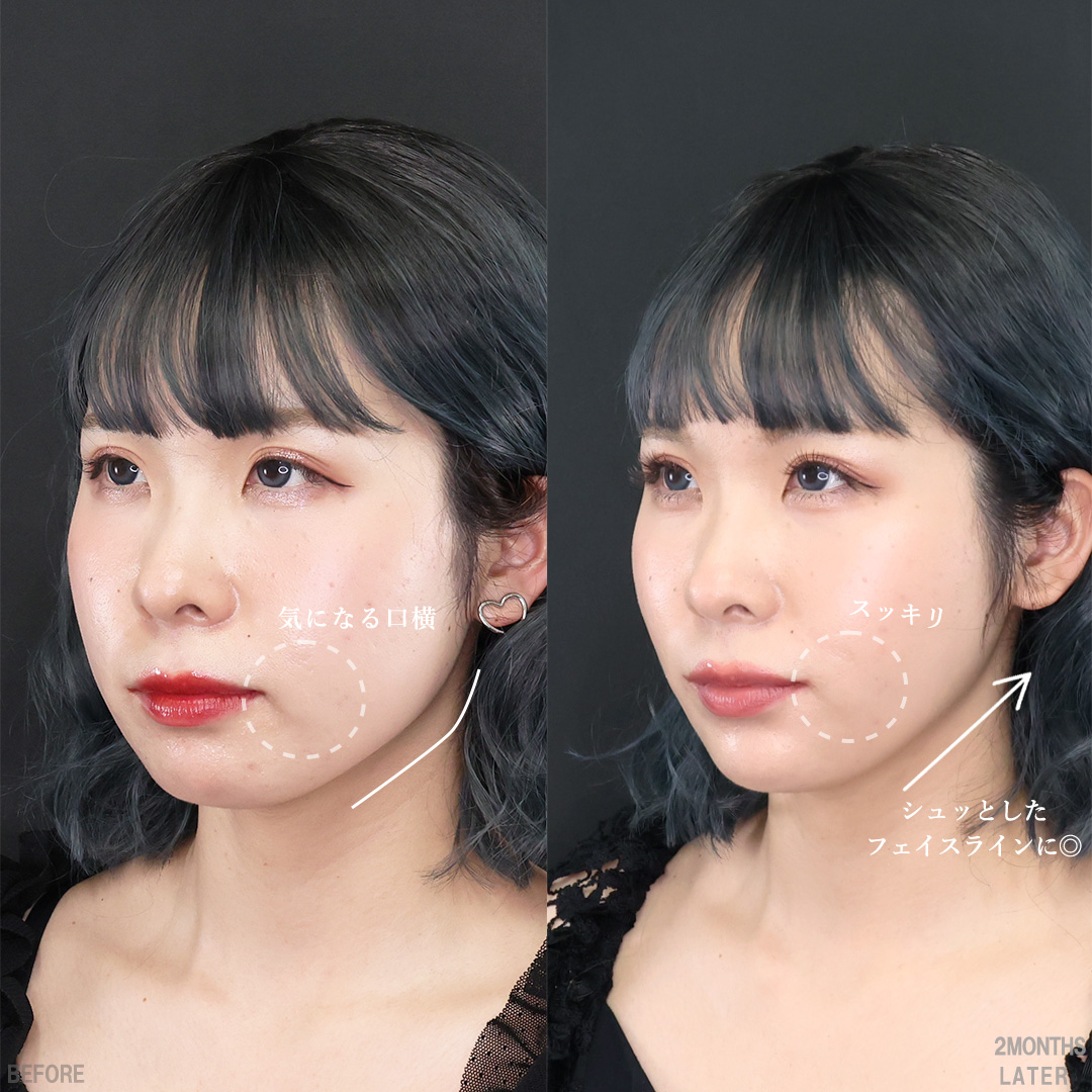 TAC式 ツヤ肌コラーゲンリフト®/ジョールファット除去/バッカルファット除去の症例写真 施術前後 