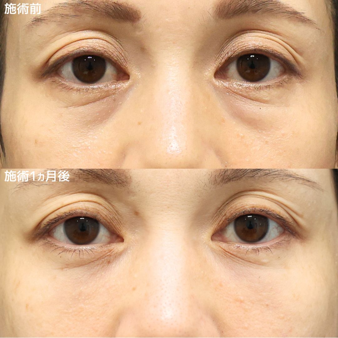 下眼瞼脱脂術（目の下のたるみ取り・目の下の脂肪ふくらみ取り）の症例写真 施術前後 