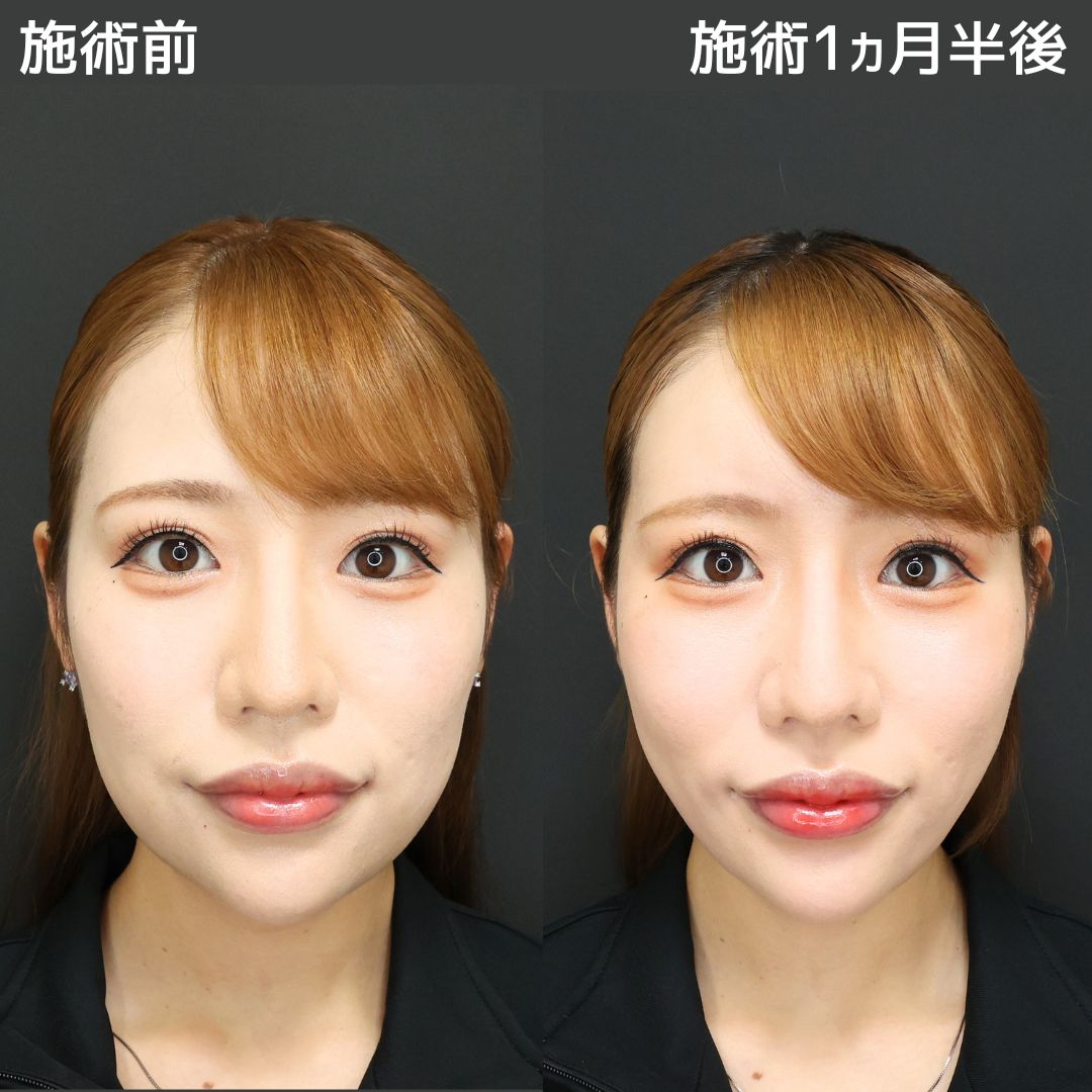 TAC式 ツヤ肌コラーゲンリフト®/ジョールファット除去/顎下の脂肪吸引の症例写真 施術前後 