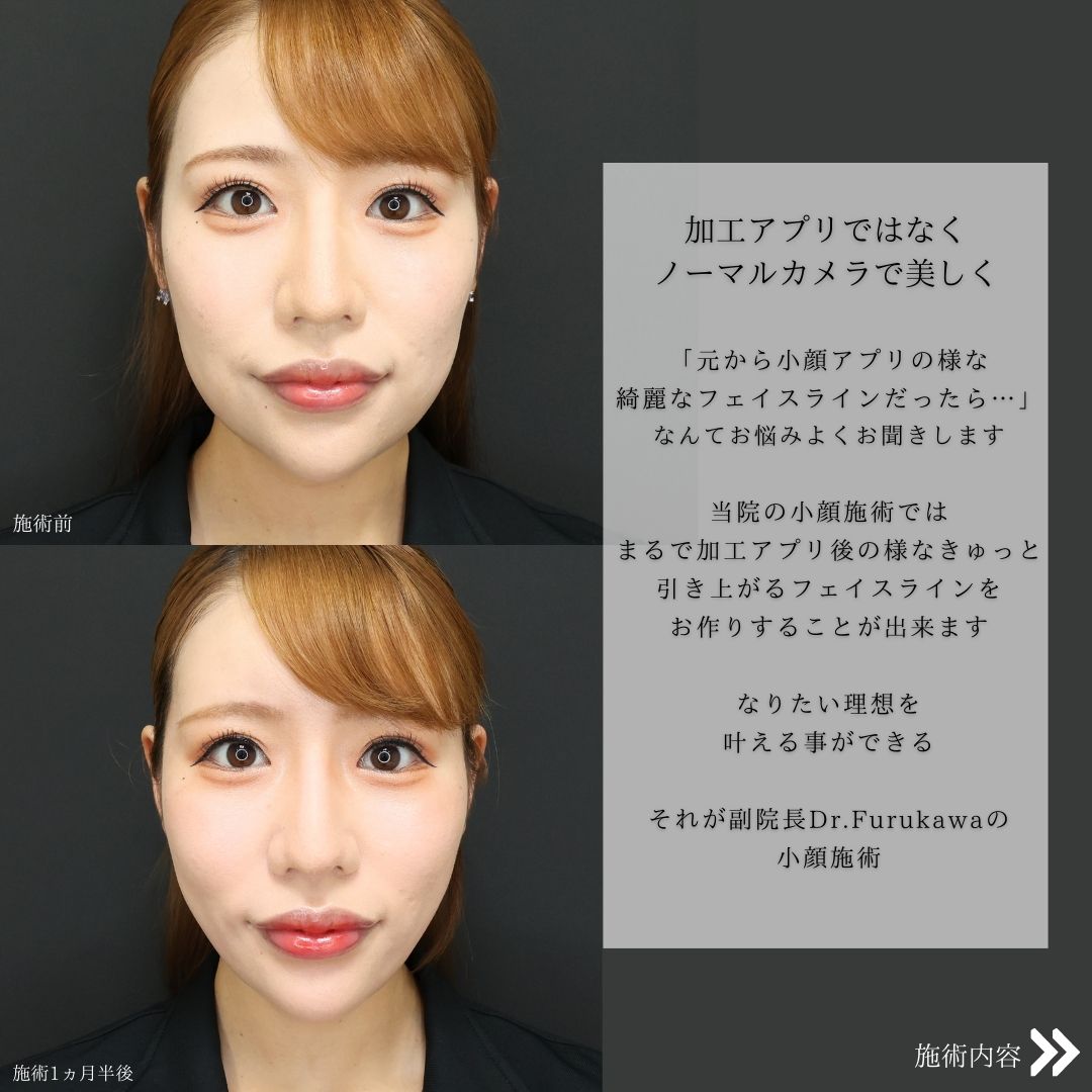 TAC式 ツヤ肌コラーゲンリフト®/ジョールファット除去/顎下の脂肪吸引の症例写真 施術前後 
