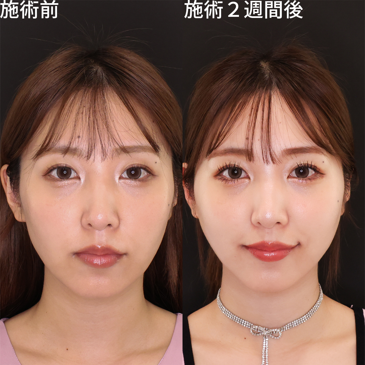 TAC式 ツヤ肌コラーゲンリフト®の症例写真 施術前後 