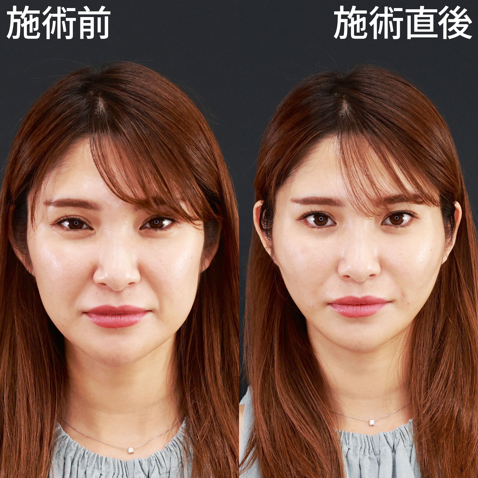 ほうれい線のヒアルロン酸注射/TAC式 ツヤ肌コラーゲンリフト®の症例写真 施術前後 
