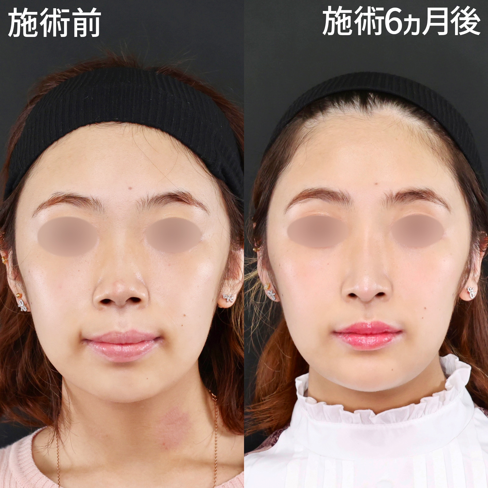 鼻中隔延長術/鼻先軟骨移植/鼻尖形成・鼻尖縮小の症例写真 施術前後 
