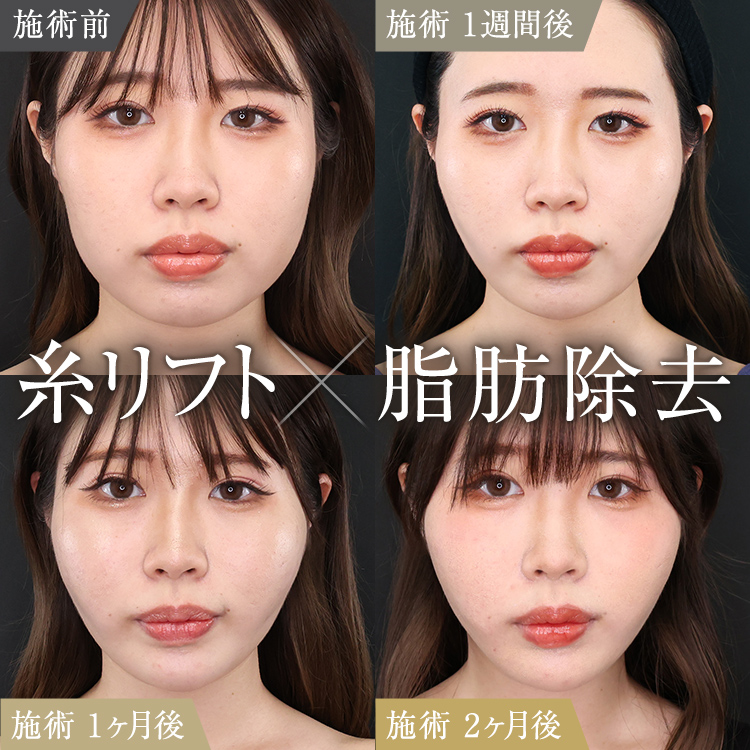 糸リフト×顔の脂肪吸引・除去｜気になるダウンタイムの様子を徹底公開