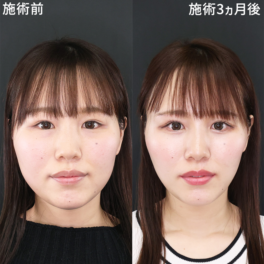 TAC式 ツヤ肌コラーゲンリフト®/バッカルファット除去/ジョールファット除去の症例写真 施術前後 