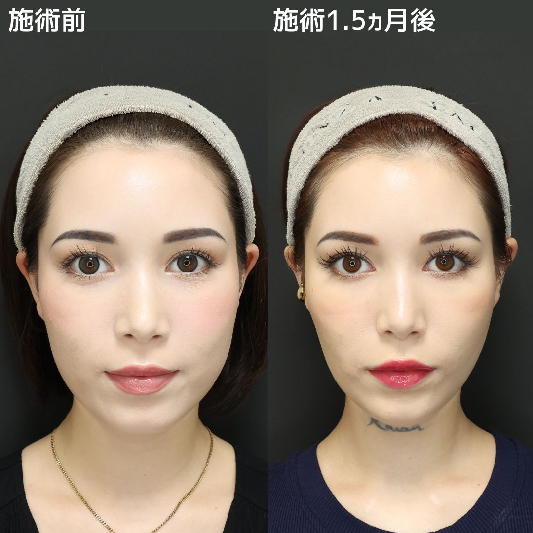 TAC式 ツヤ肌コラーゲンリフト®/バッカルファット除去/ジョールファット除去の症例写真 施術前後 