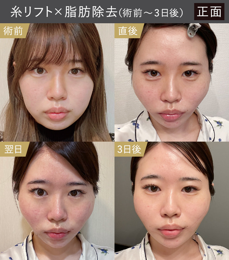 糸リフトと顔の脂肪吸引・除去｜術前・直後・翌日・3日後の正面のダウンタイム症例画像
