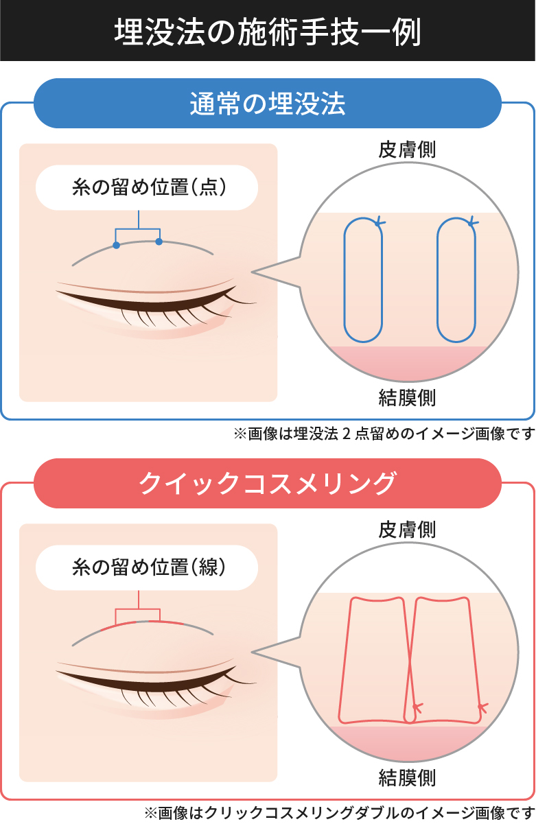 埋没法の手技例　埋没法は糸玉（点）によって二重を形成します。クックコスメリングは糸線で二重ラインを形成します。