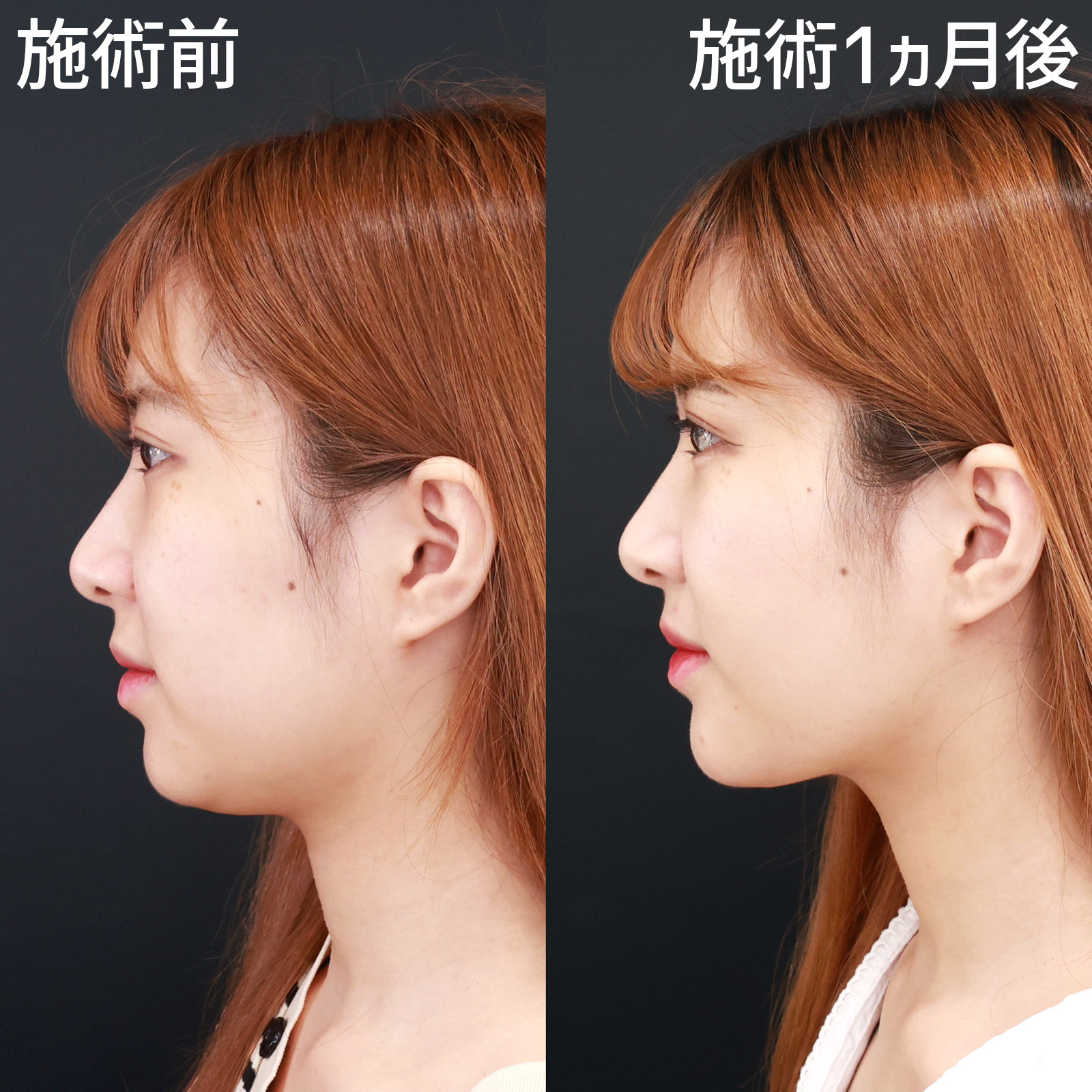 【顎下脂肪吸引】脂肪で埋もれたフェイスラインがクッキリ!!女優級の輪郭に。