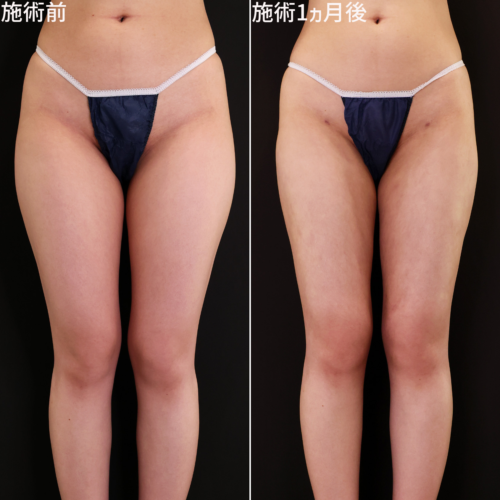 体の脂肪吸引の症例写真 施術前後 