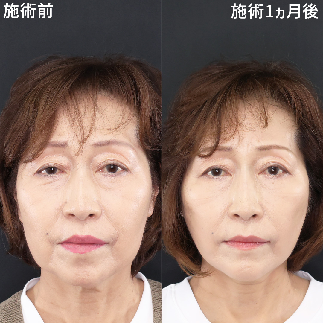 TAC式 ツヤ肌コラーゲンリフト®/TAC式 ショッピングリフト/ゴルゴ線のヒアルロン酸注射の症例写真 施術前後 