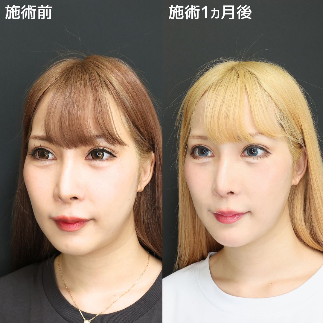TAC式 ツヤ肌コラーゲンリフト®/顎のヒアルロン酸注射/エラボトックス注射の症例写真 施術前後 