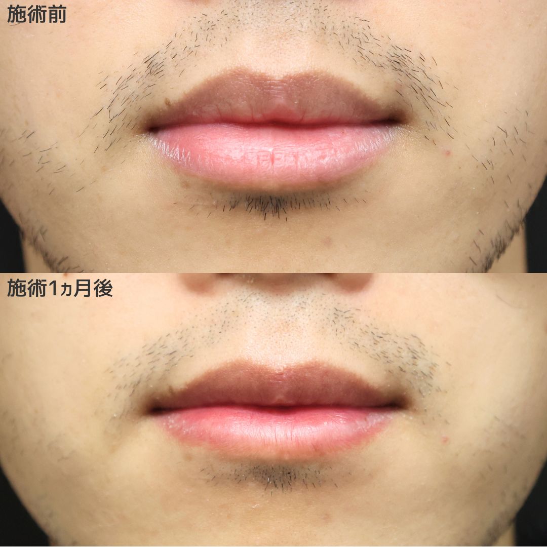 口唇縮小術の症例写真 施術前後 