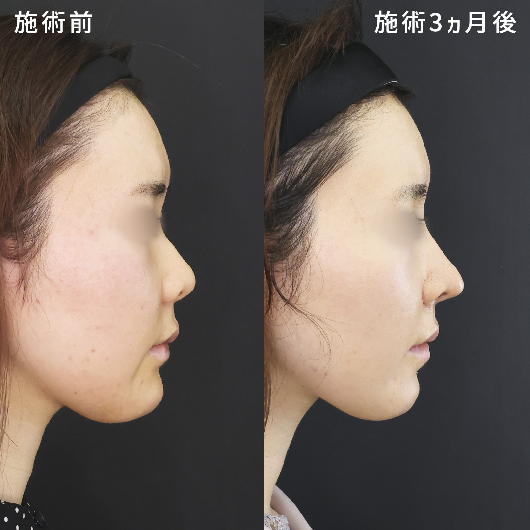 鼻中隔延長術/鼻尖形成・鼻尖縮小/鼻先軟骨移植の症例写真 施術前後 