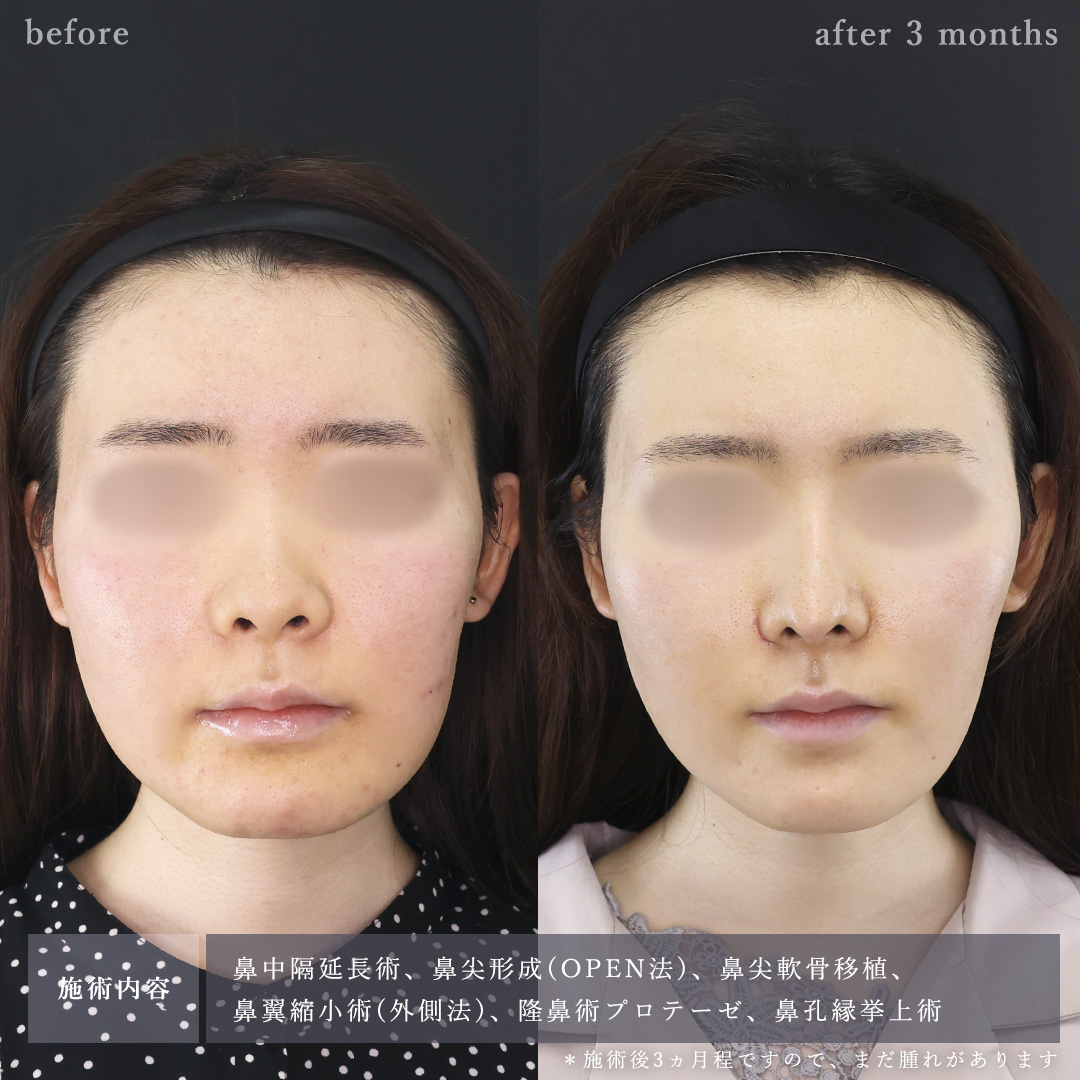 鼻中隔延長術/鼻尖形成・鼻尖縮小/鼻先軟骨移植の症例写真 施術前後 