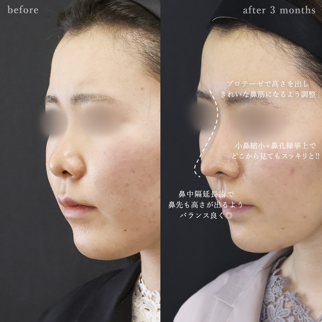 鼻中隔延長術/鼻尖形成・鼻尖縮小/鼻先軟骨移植の症例写真 施術前後 