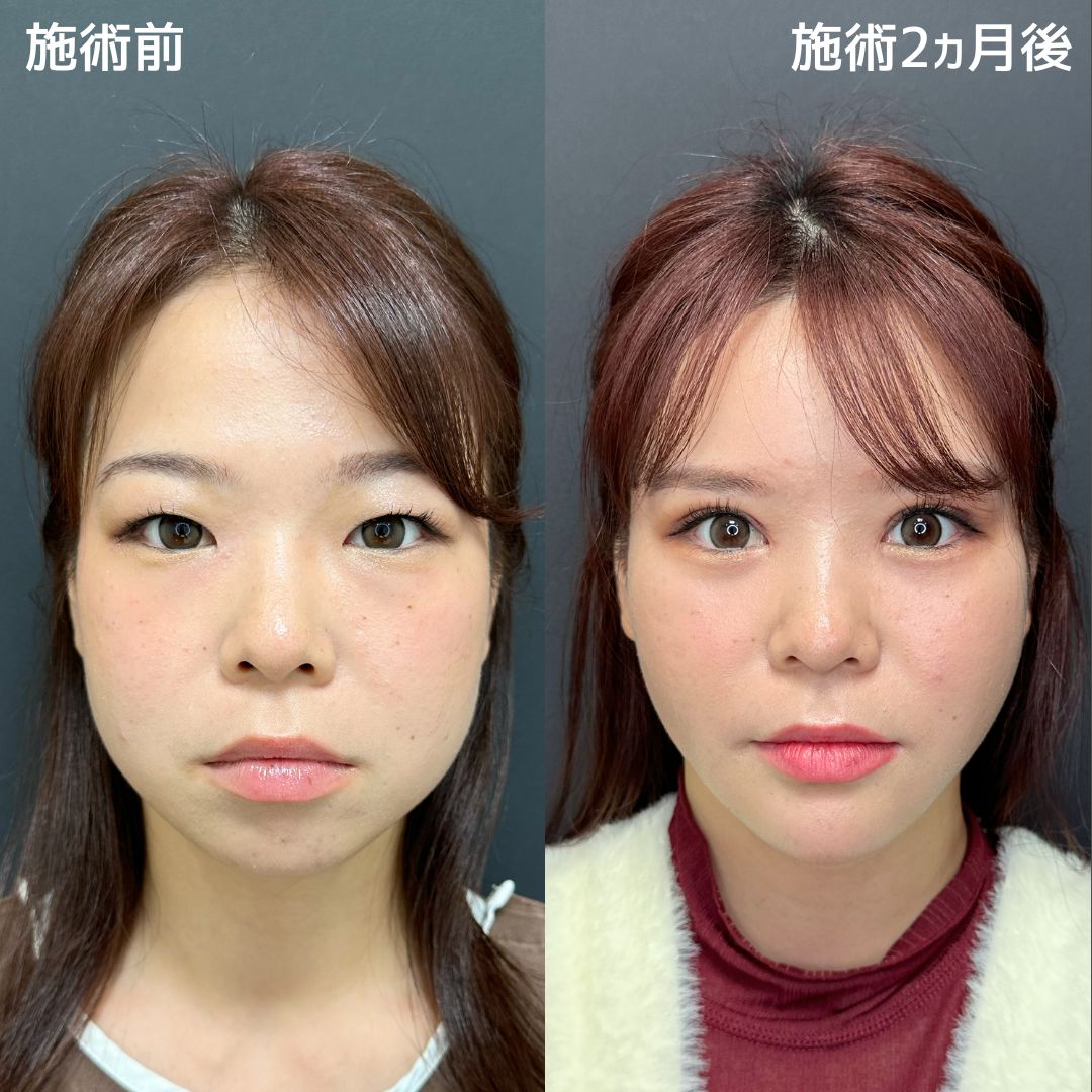 バッカルファット除去/ジョールファット除去/小顔整形｜パーフェクトフェイスラインの症例写真 施術前後 