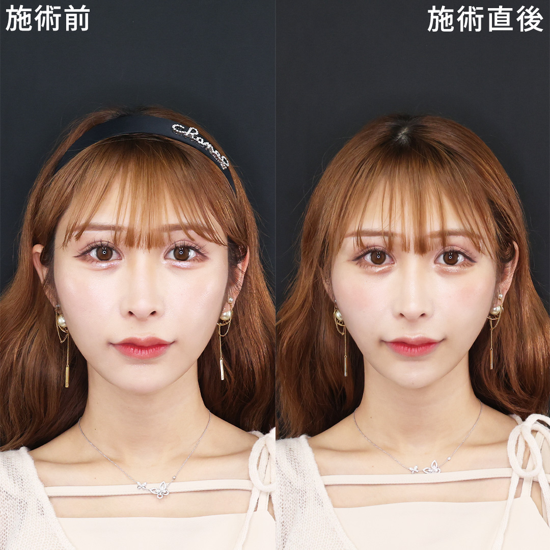 TAC式 ツヤ肌コラーゲンリフト®/顎のヒアルロン酸注射/涙袋形成（ヒアルロン酸注射）の症例写真 施術前後 