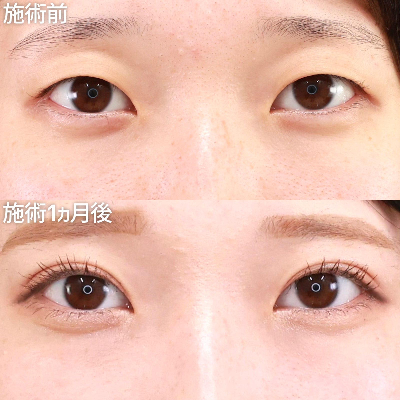 二重埋没法の症例写真 施術前後 