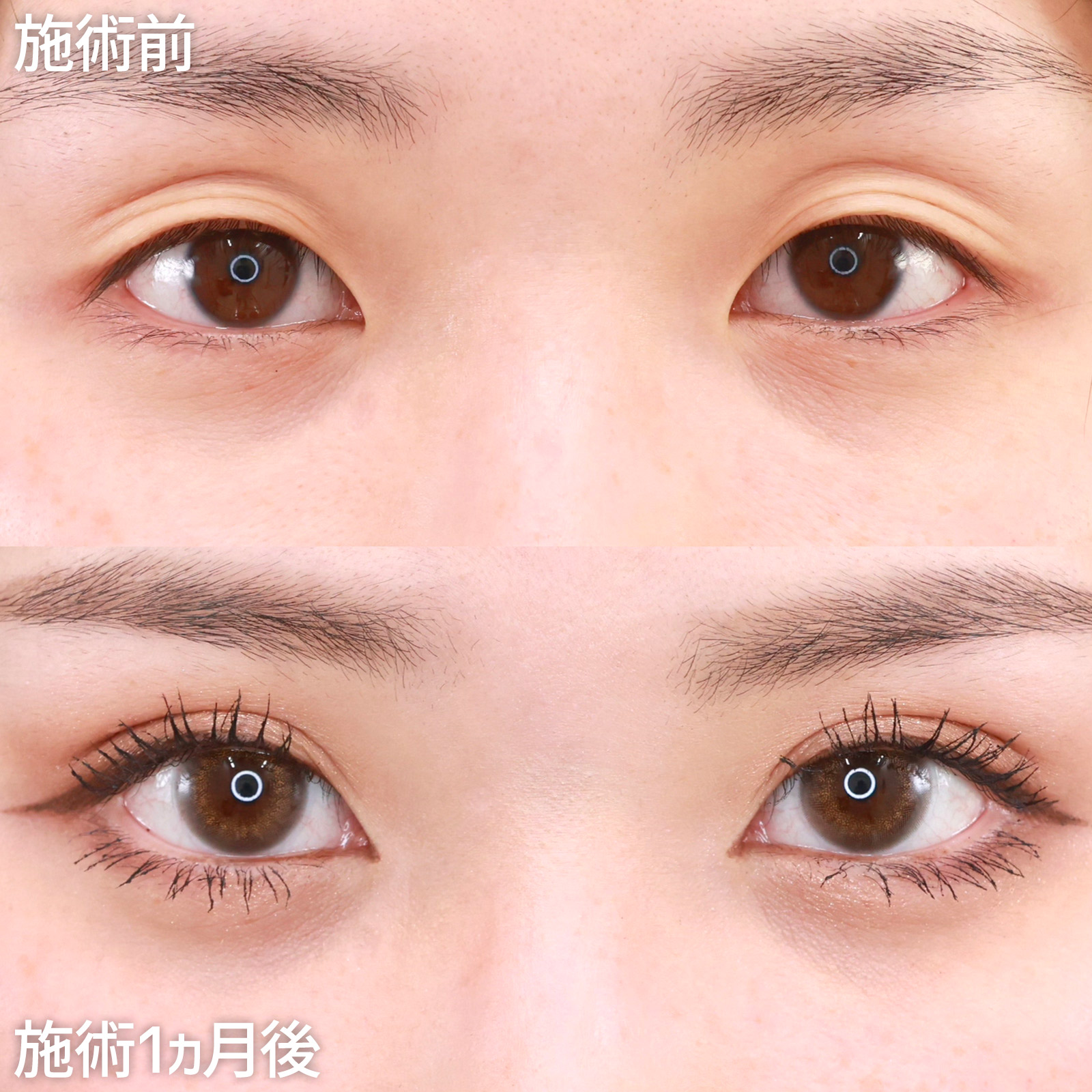 【二重埋没法】たるみ瞼もスッキリとした平行二重に変身！