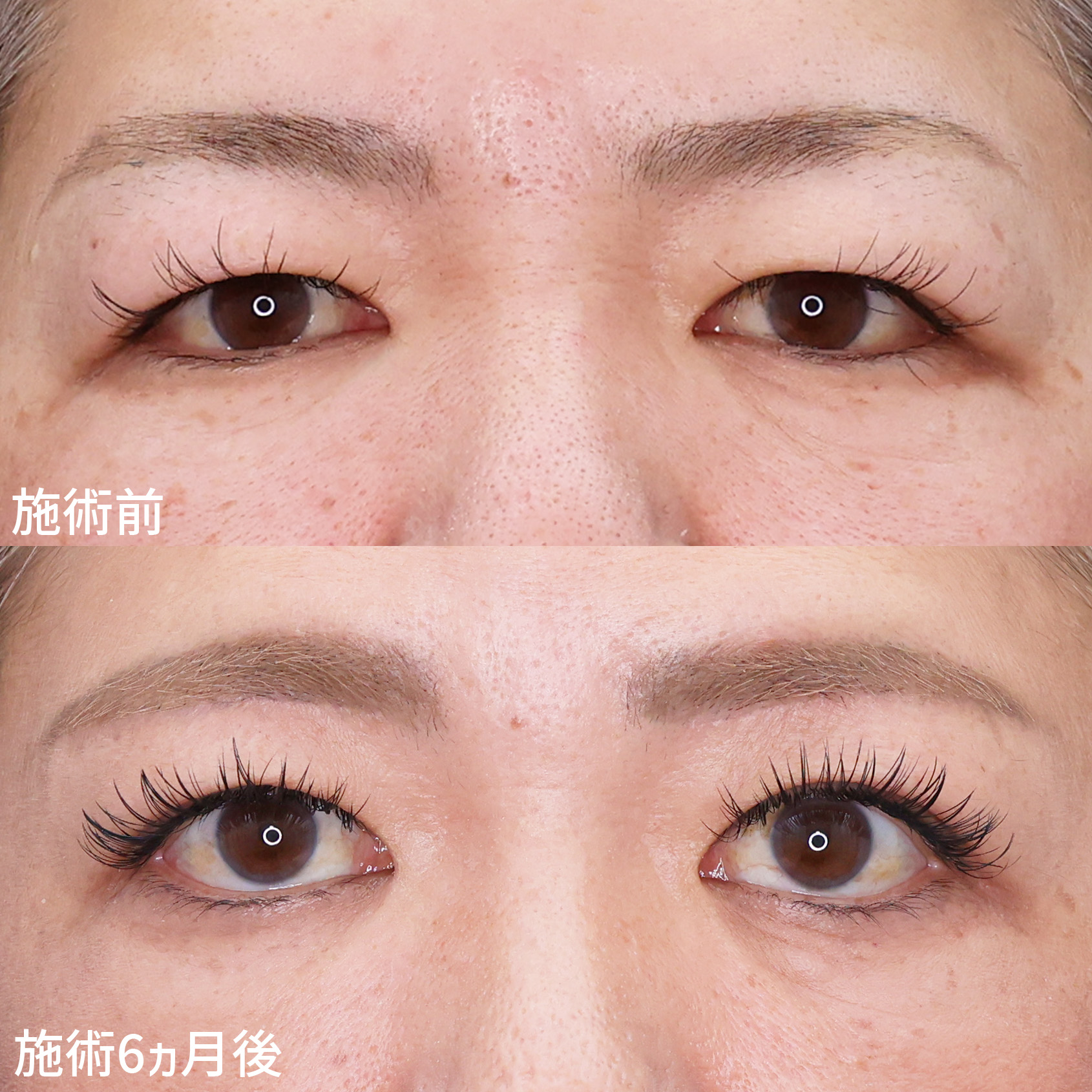 眉毛下切開術の症例写真 施術前後 