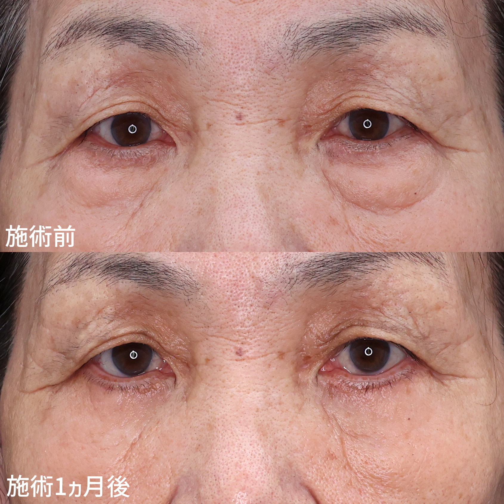 下眼瞼切開術（クマ・たるみとり）/下眼瞼脱脂術（目の下のたるみ取り・目の下の脂肪ふくらみ取り）の症例写真 施術前後 
