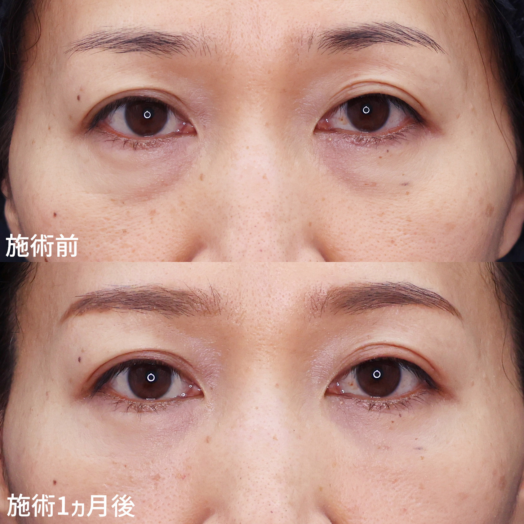 下眼瞼脱脂術（目の下のたるみ取り・目の下の脂肪ふくらみ取り）/目の下のヒアルロン酸注射の症例写真 施術前後 