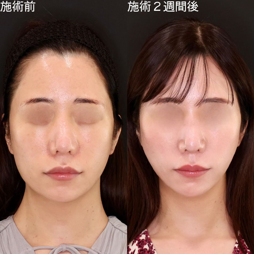 TAC式 ツヤ肌コラーゲンリフト®の症例写真 施術前後 