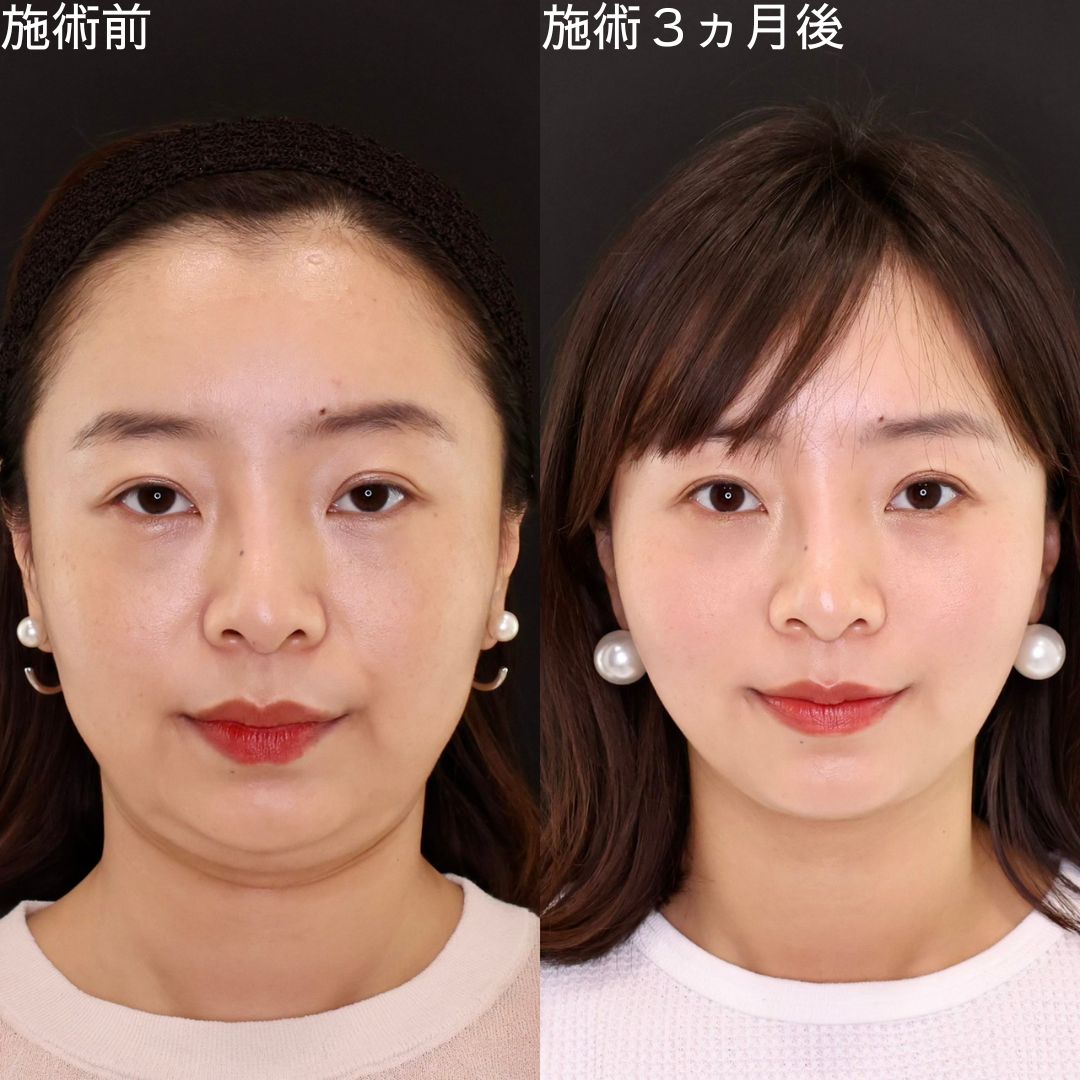 【糸リフト】本来の輪郭を引き出す！Dr.石橋の別人級小顔術