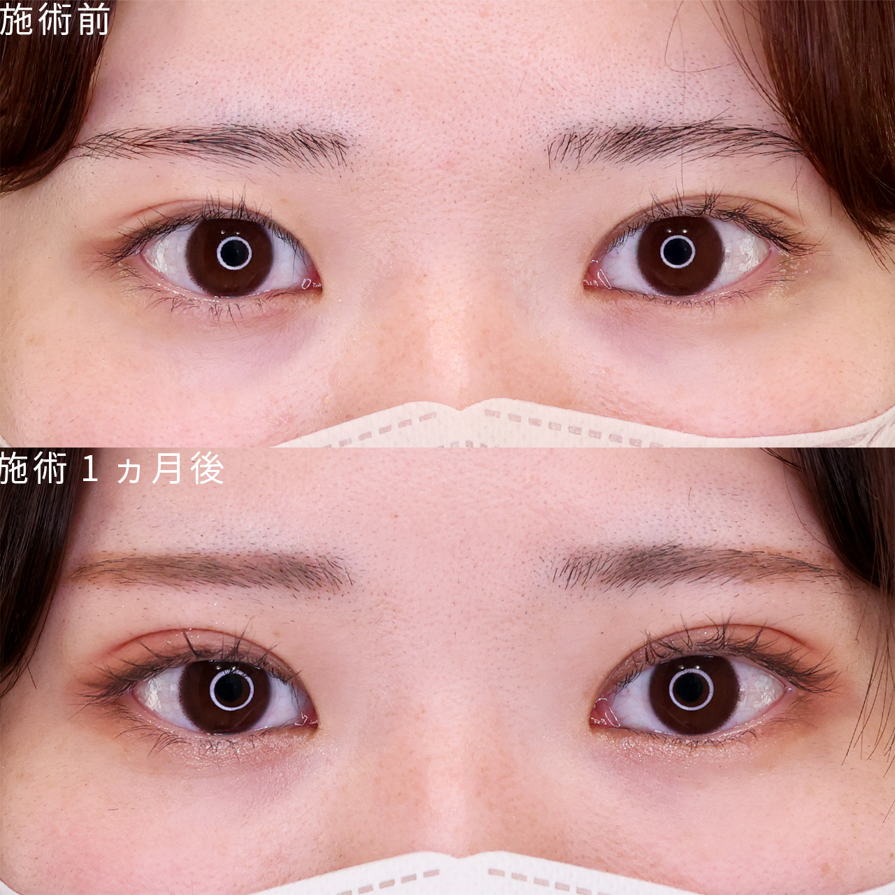 二重埋没法の症例写真 施術前後 