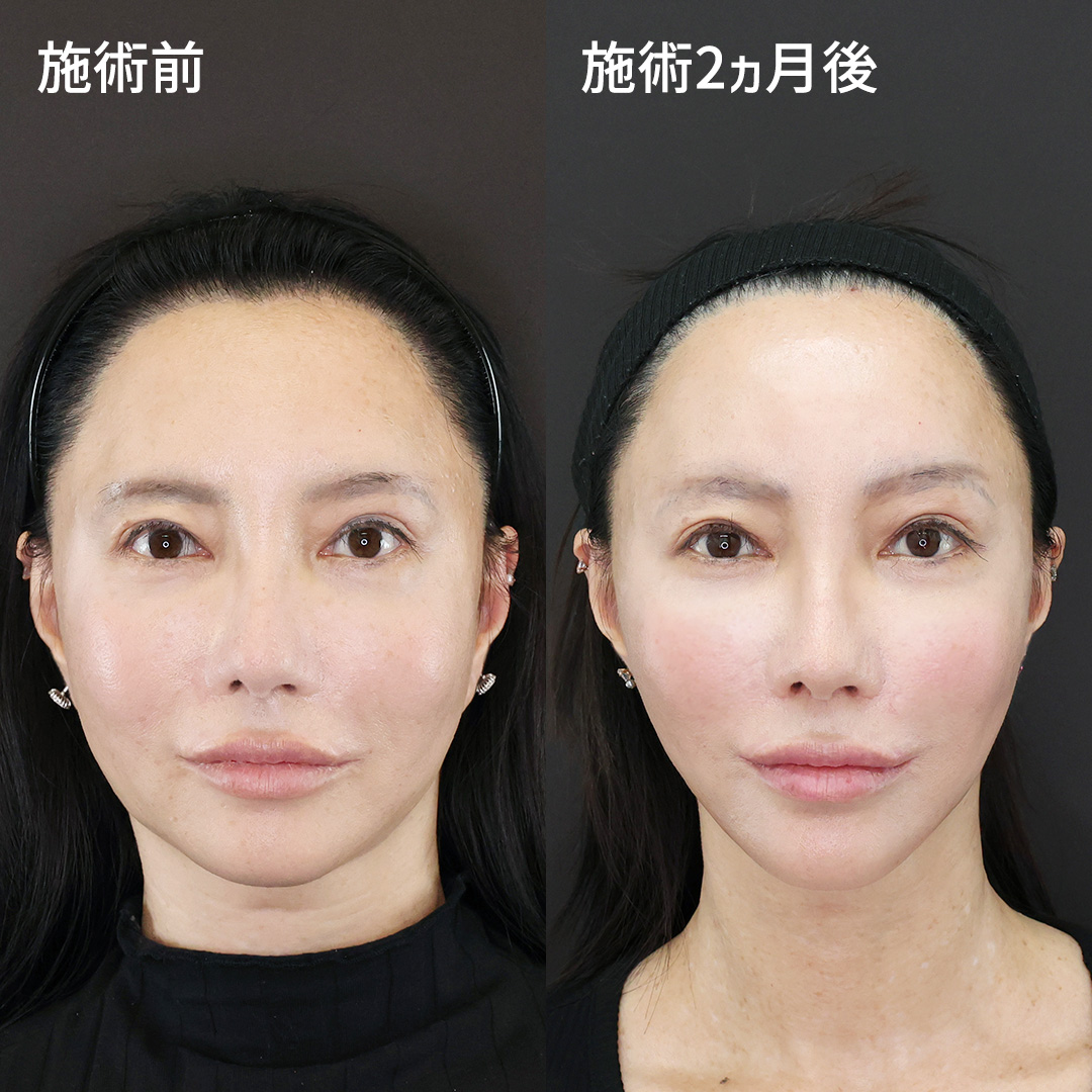 目の下のヒアルロン酸注射/TAC式 ツヤ肌コラーゲンリフト®の症例写真 施術前後 