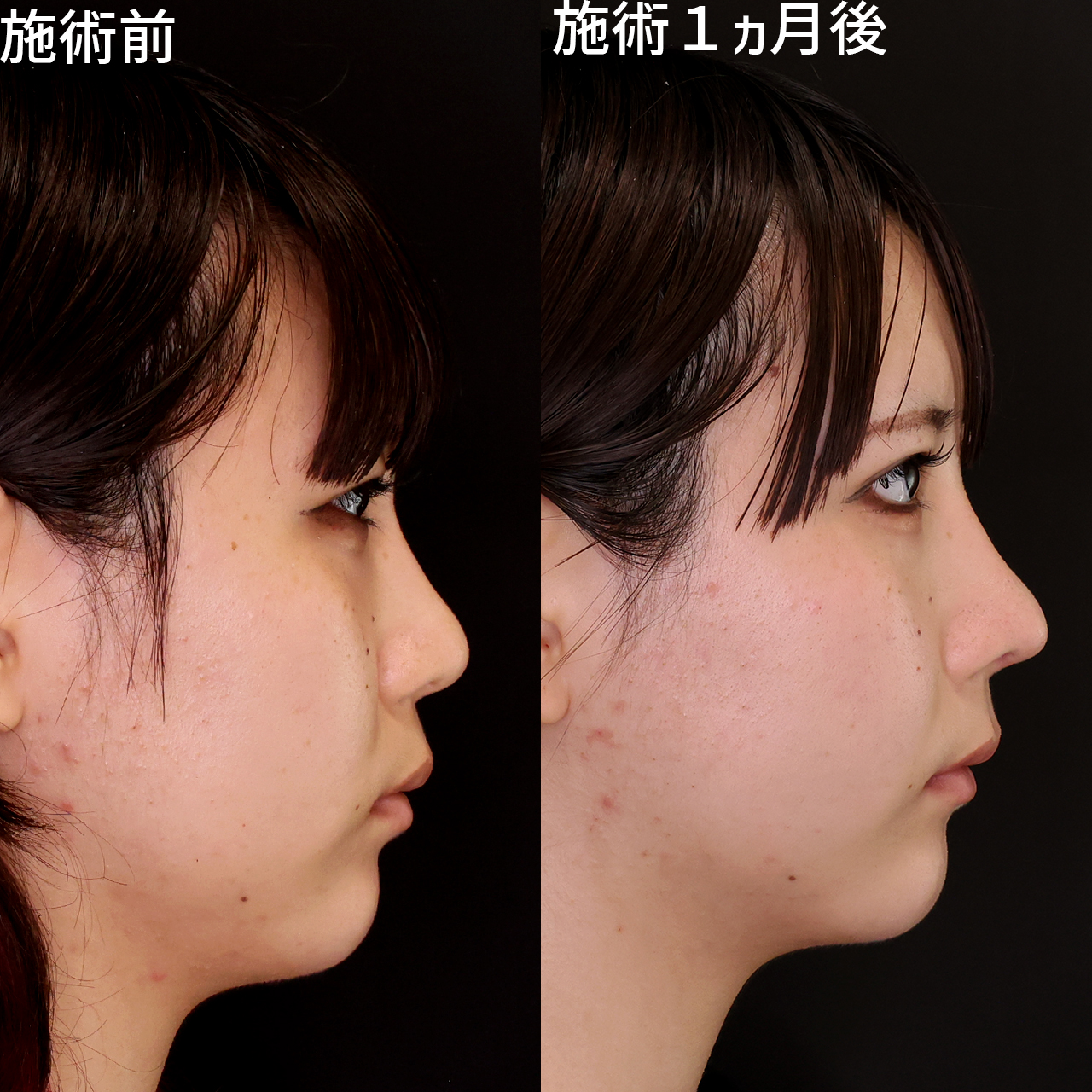 鼻中隔延長術/鼻先軟骨移植/鼻尖形成・鼻尖縮小の症例写真 施術前後 