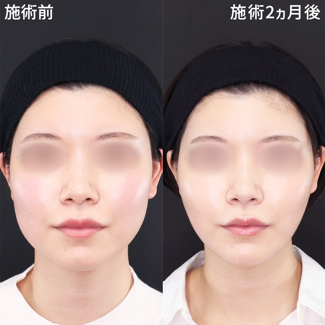 TAC式 ツヤ肌コラーゲンリフト®/TAC式 ショッピングリフト/ジョールファット除去の症例写真 施術前後 