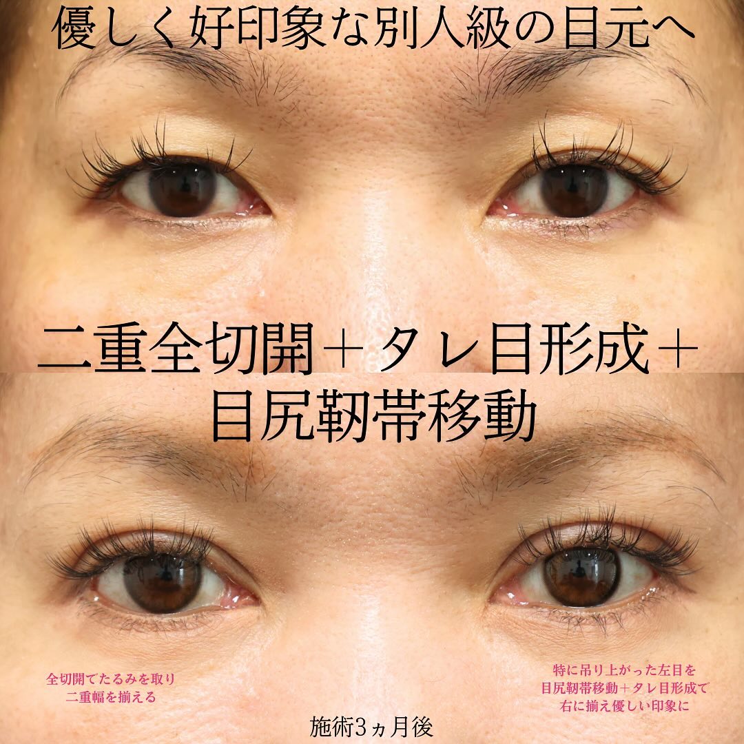 二重切開（全切開法）/グラマラスライン（タレ目形成）/目尻靭帯移動術の症例写真 施術前後 