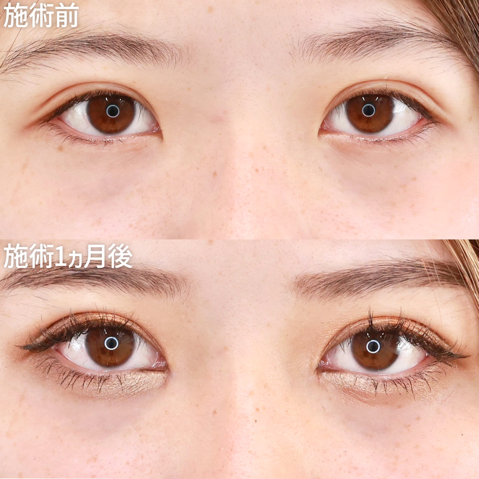 目頭切開術の症例写真 施術前後 