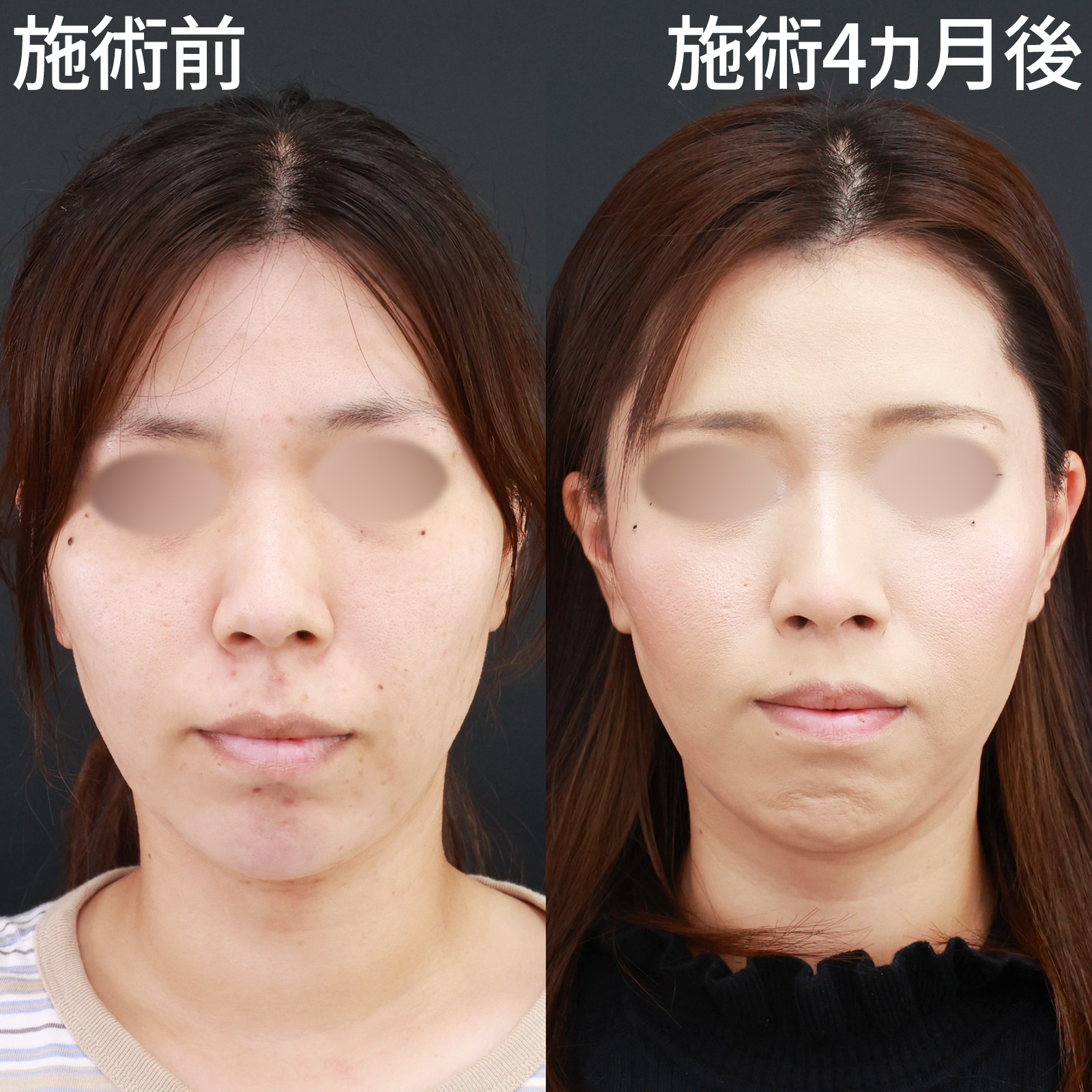 人中短縮術(リップリフト)・外側人中短縮術の症例写真 施術前後 