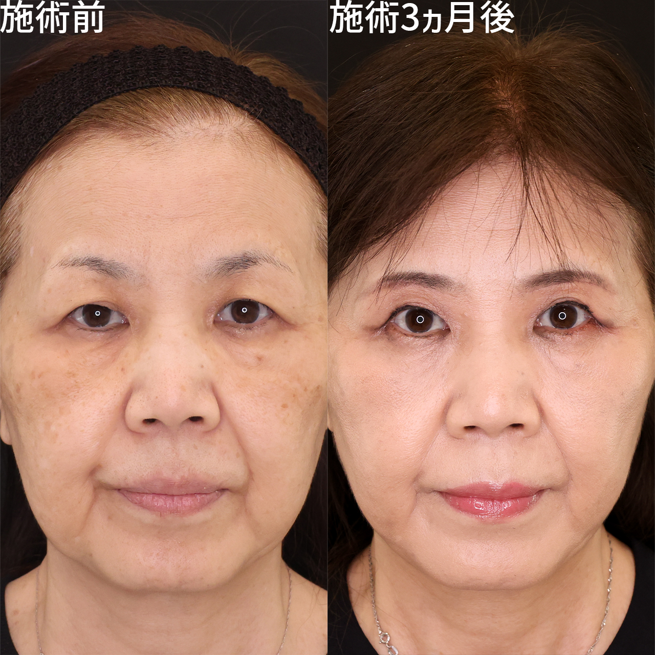 眉毛下切開術/ジョールファット除去/TAC式 ツヤ肌コラーゲンリフト®の症例写真 施術前後 
