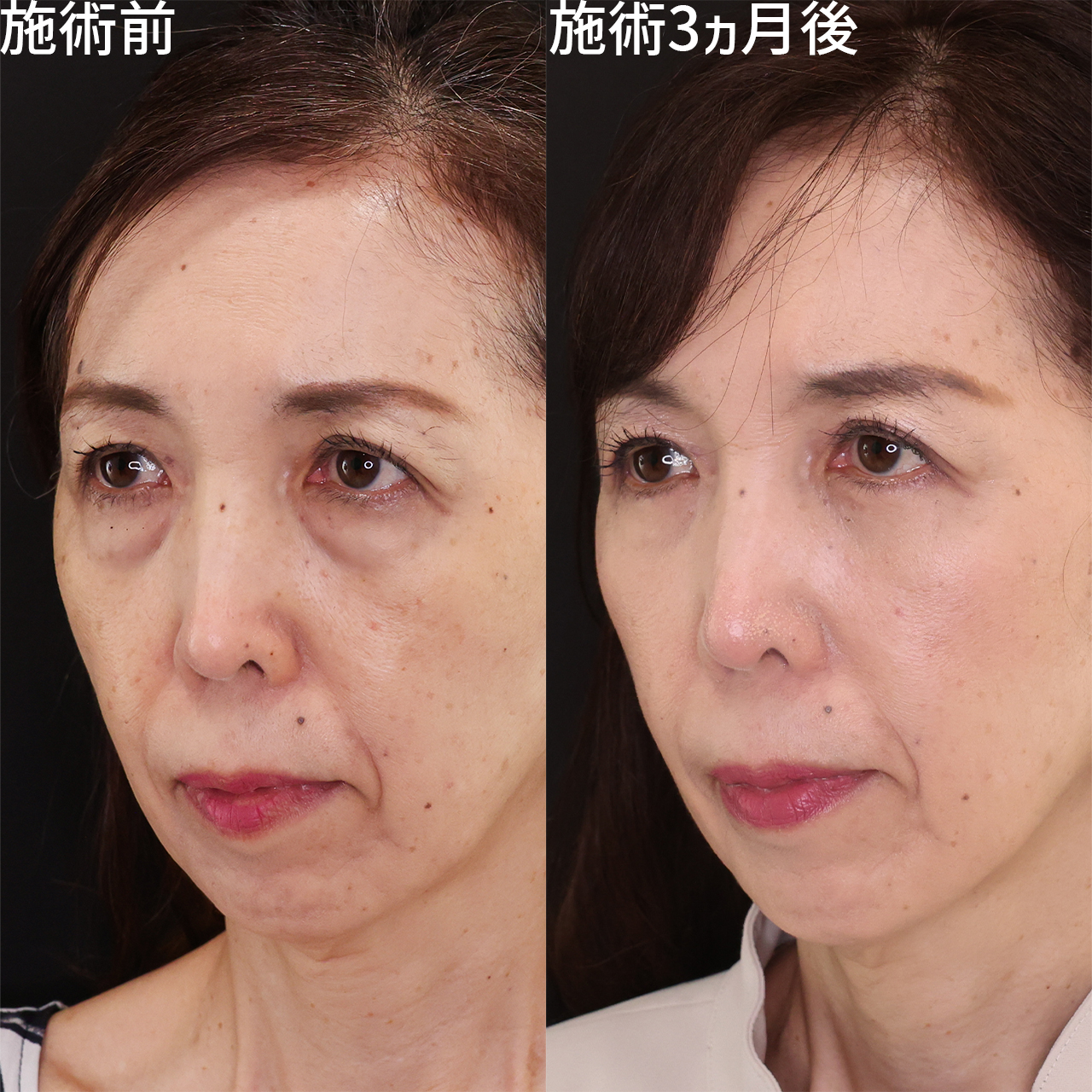 下眼瞼切開術（クマ・たるみとり）/下眼瞼脱脂術（目の下のたるみ取り・目の下の脂肪ふくらみ取り）の症例写真 施術前後 
