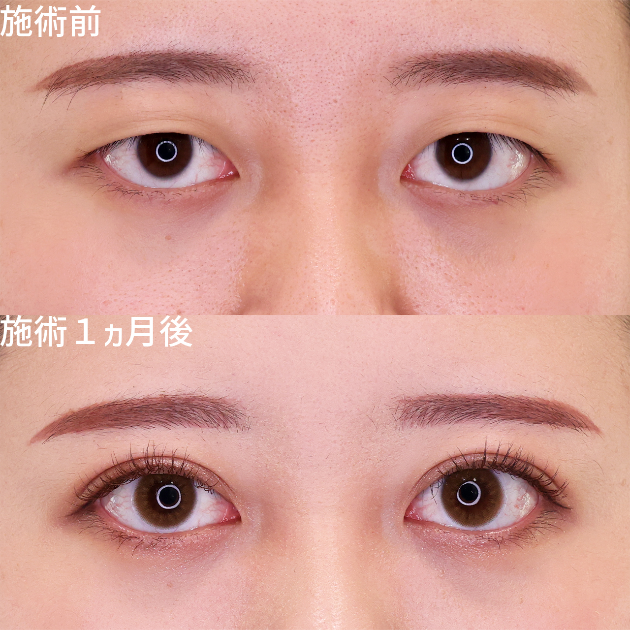 二重埋没法の症例写真 施術前後 