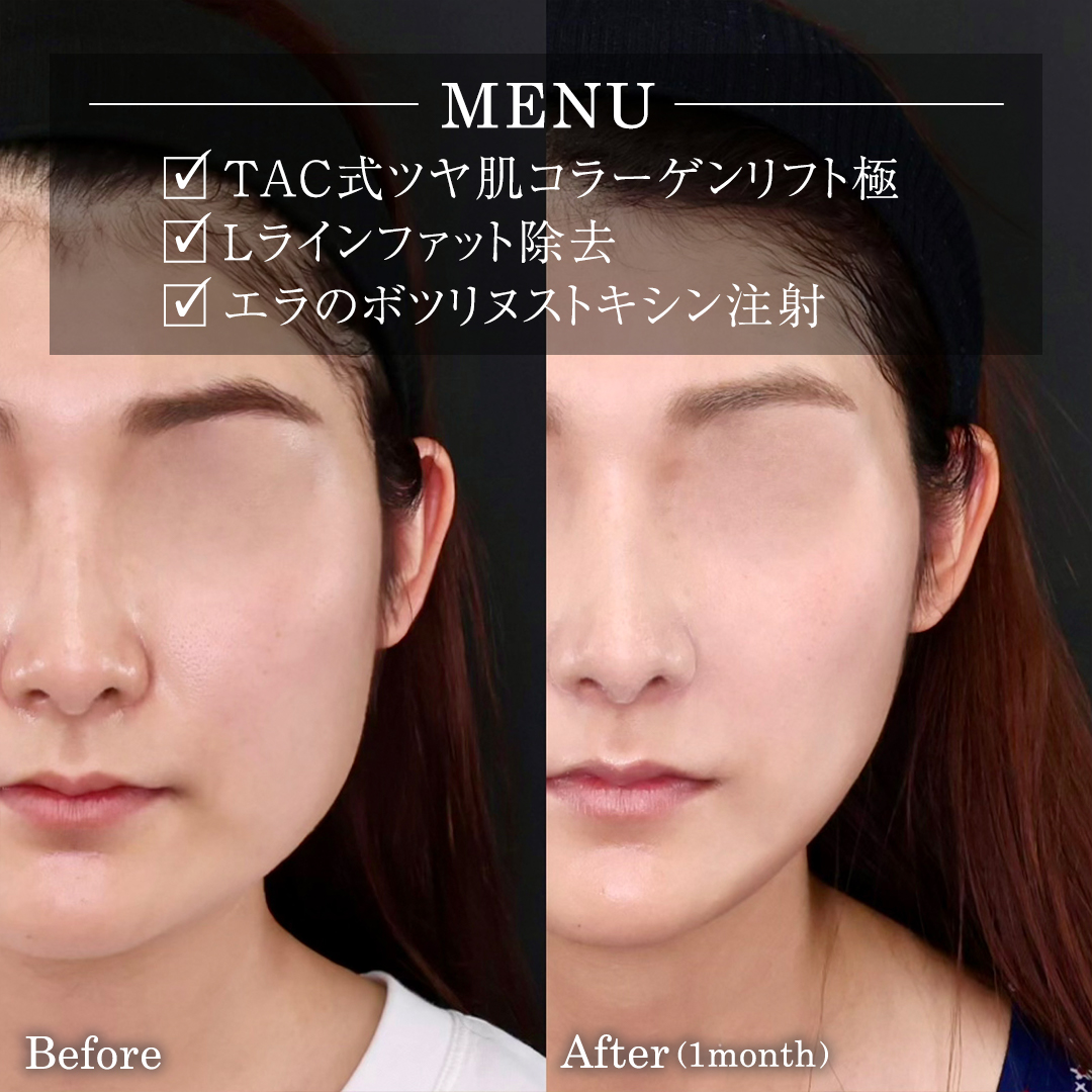 TAC式 ツヤ肌コラーゲンリフト®/Lラインファット除去（エラ下脂肪除去）/エラボトックス注射の症例写真 施術前後 