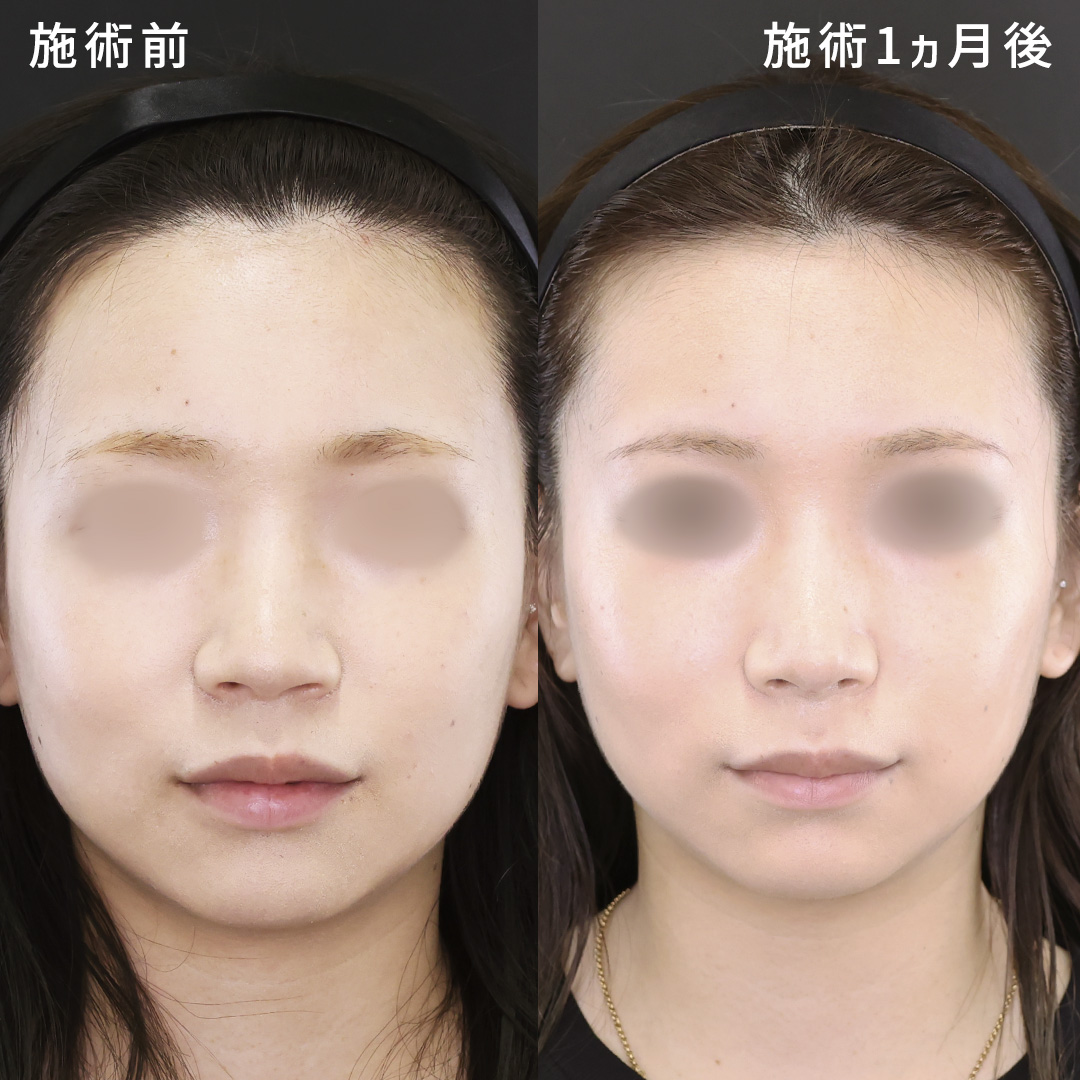 鼻尖形成・鼻尖縮小/鼻先軟骨移植の症例写真 施術前後 