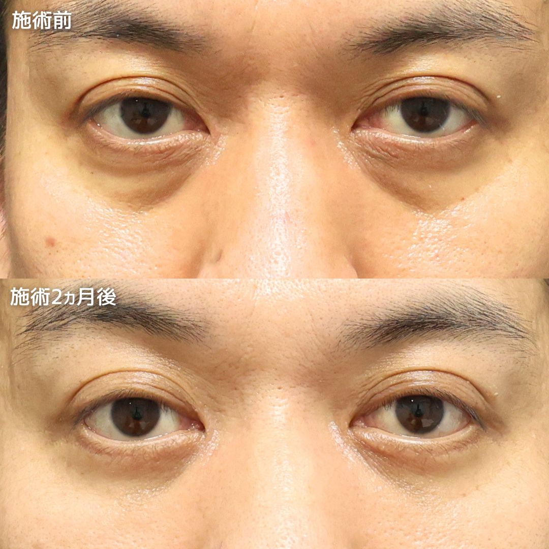 下眼瞼切開術（クマ・たるみとり）/下眼瞼脱脂術（目の下のたるみ取り・目の下の脂肪ふくらみ取り）/目の下のヒアルロン酸注射の症例写真 施術前後 