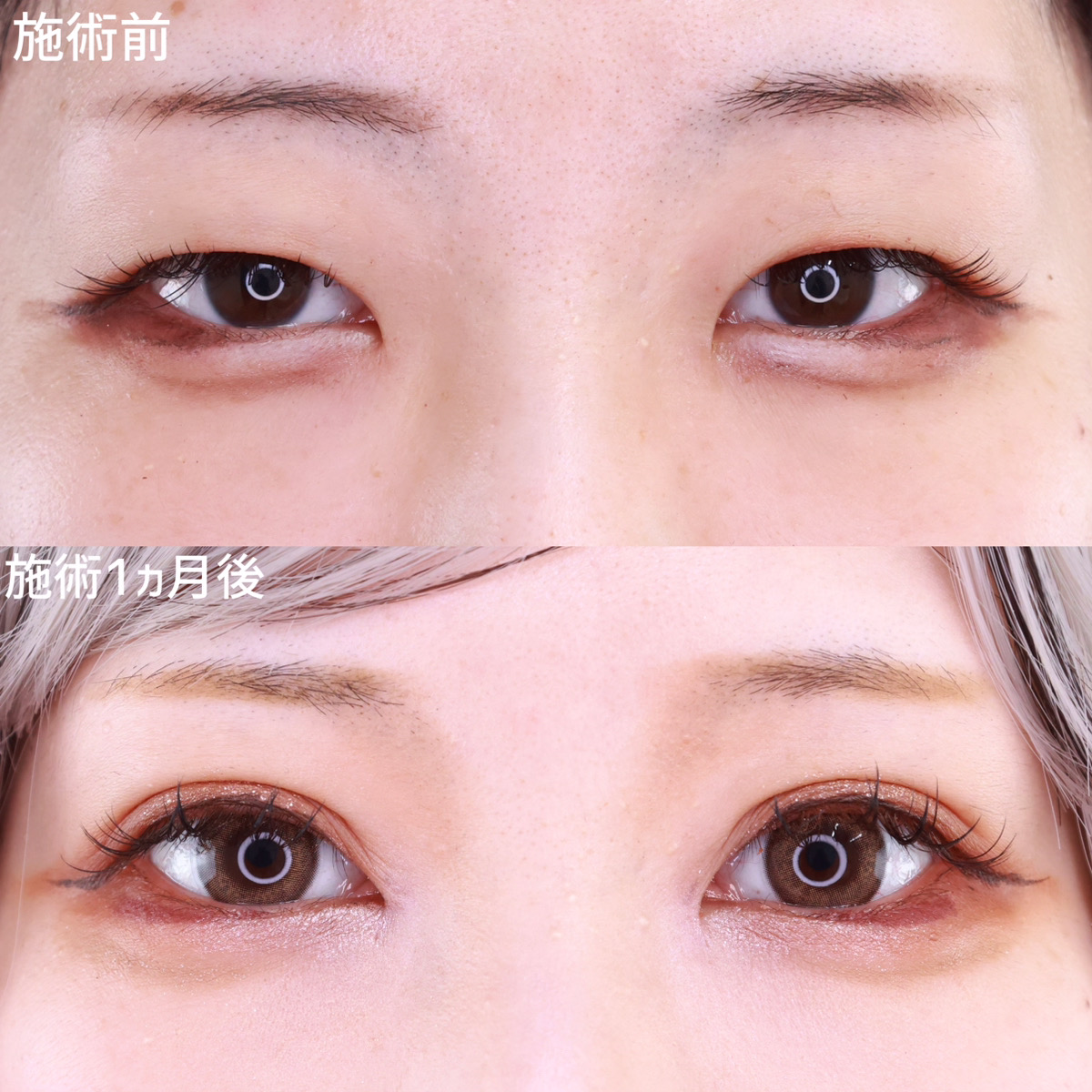 二重埋没法/目頭切開術/目元：その他の症例写真 施術前後 