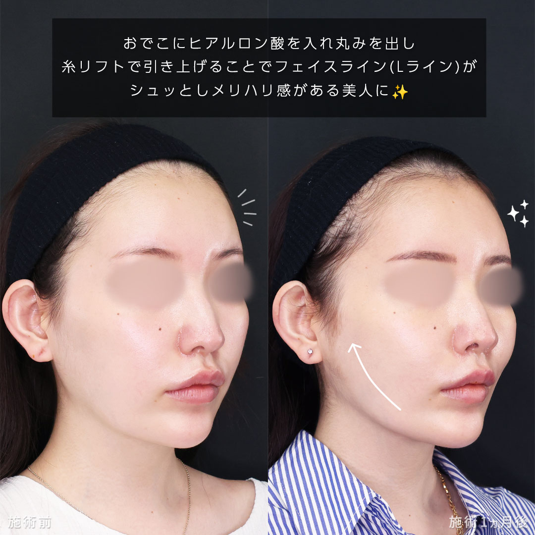 おでこボトックス注射/おでこ・こめかみのヒアルロン酸注射/ヒアルロン酸注射：その他の症例写真 施術前後 