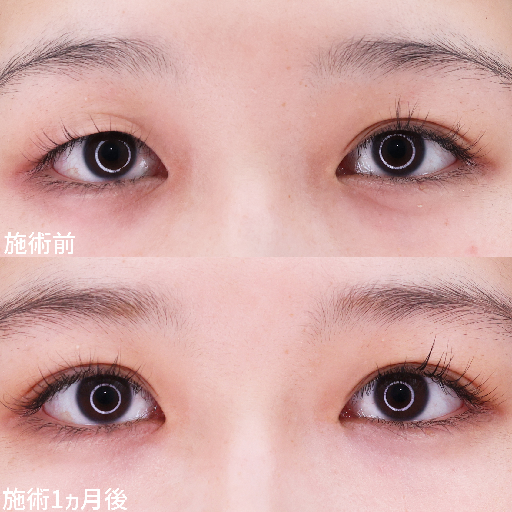 二重埋没法/片目二重術（片目だけ整形したい方）の症例写真 施術前後 