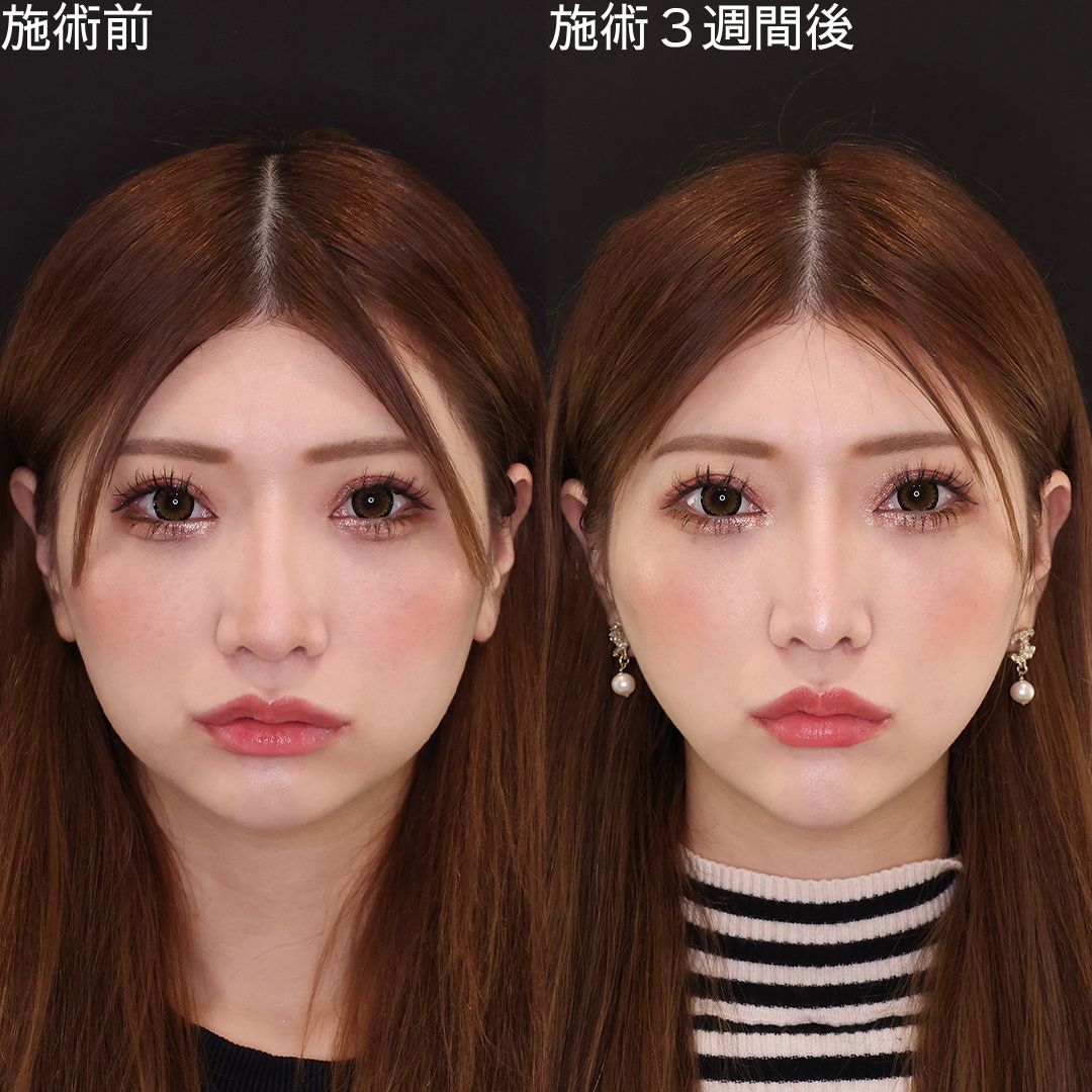 TAC式 ツヤ肌コラーゲンリフト®/エラボトックス注射の症例写真 施術前後 