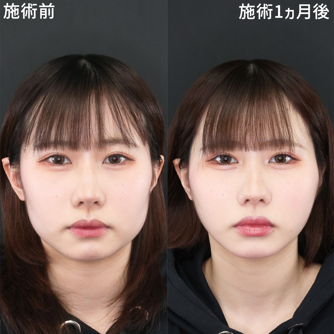 ３０分で下膨れを改善｜気になる輪郭の美容整形