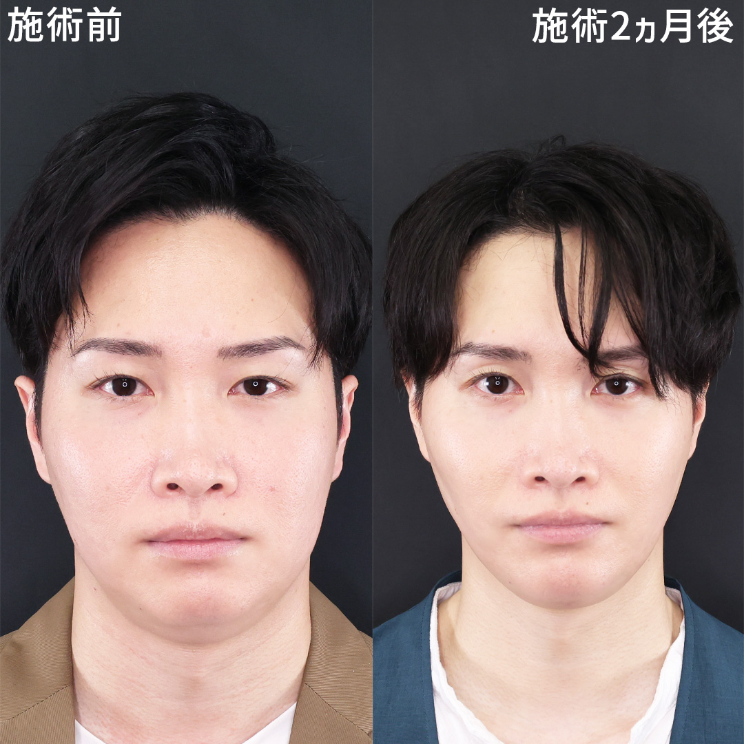 TAC式 ツヤ肌コラーゲンリフト®/TAC式 ショッピングリフト/バッカルファット除去の症例写真 施術前後 
