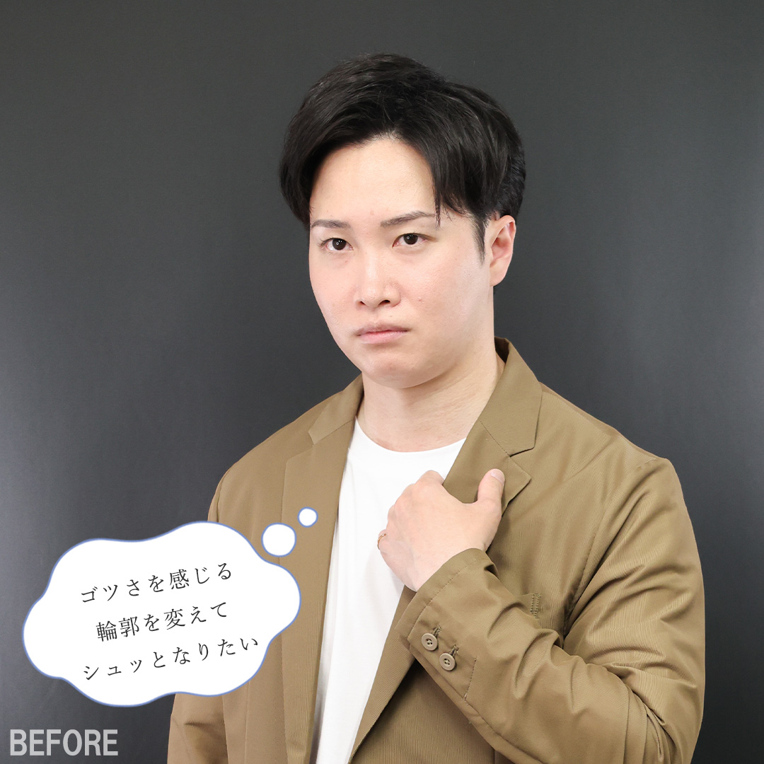 TAC式 ツヤ肌コラーゲンリフト®/TAC式 ショッピングリフト/バッカルファット除去の症例写真 施術前後 